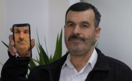 Ağrı ve yüz bozulmalarının sebebi bilinmiyordu, tümör çıktı!